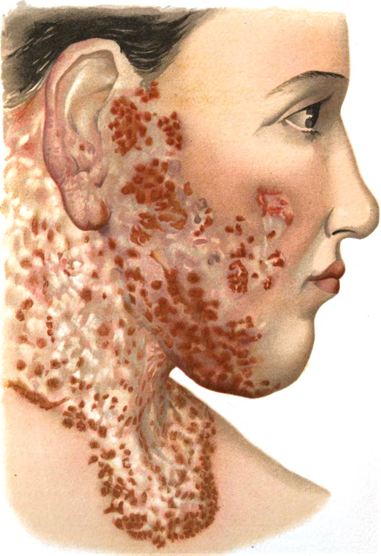 Skin nodules : MedlinePlus Medical Encyclopedia